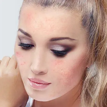 Acne & Rosacea