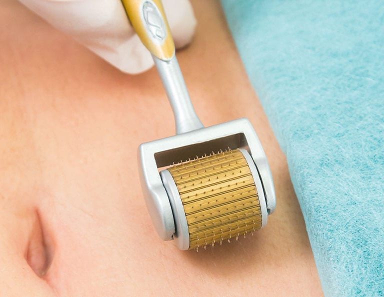 The Dermaroller may be the solution for your stretch marks