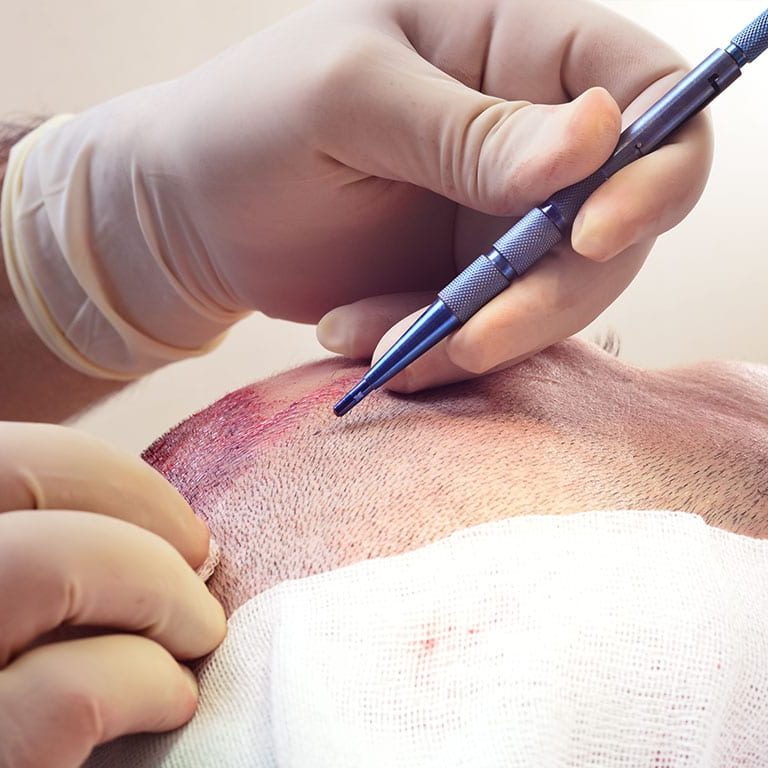 Why FUE? Hair Transplants with Dr David Taylor