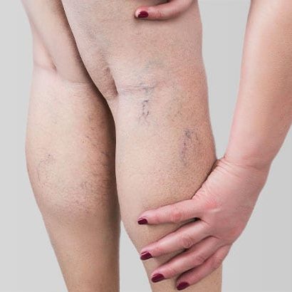 Leg Veins