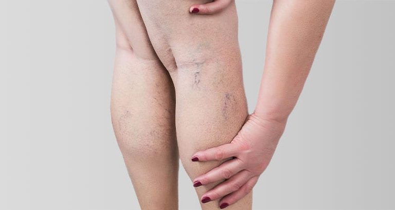 Your Spider Veins could Benefit from Sclerotherapy at North West Aesthetics