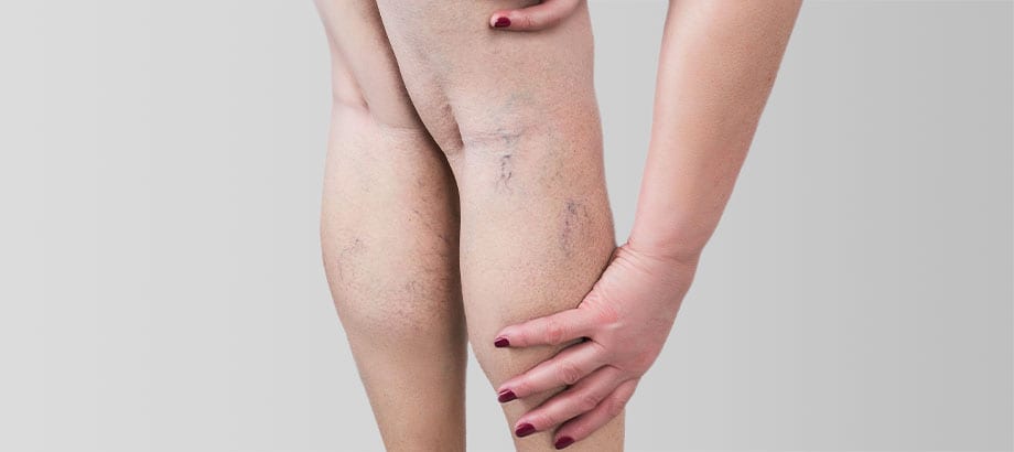 Your Spider Veins could Benefit from Sclerotherapy at North West Aesthetics