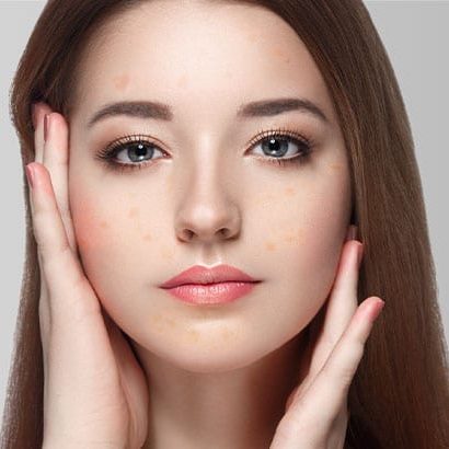 Melasma