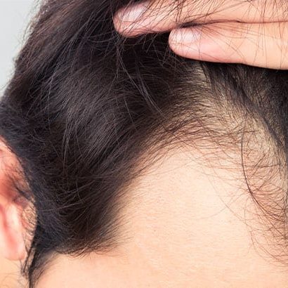 Hair Loss
