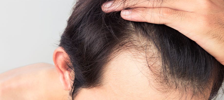 Hair Loss