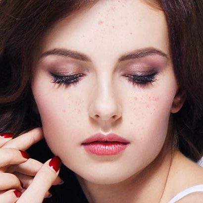 Skin Congestion