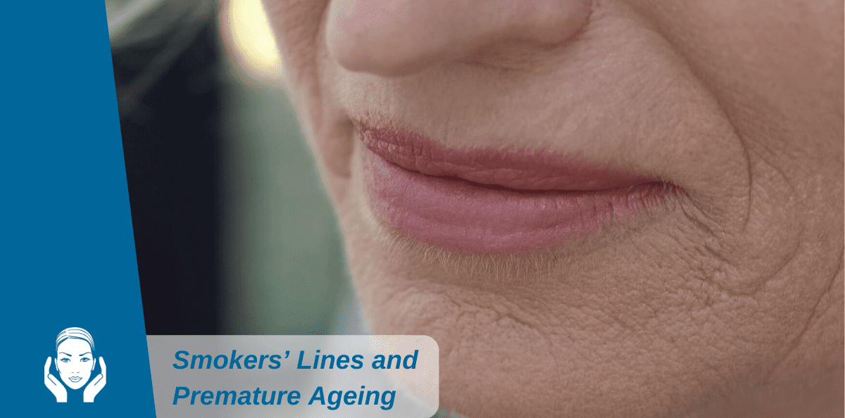 Smokers’ Lines and Premature Ageing: Make Your New Year’s Resolutions Now!