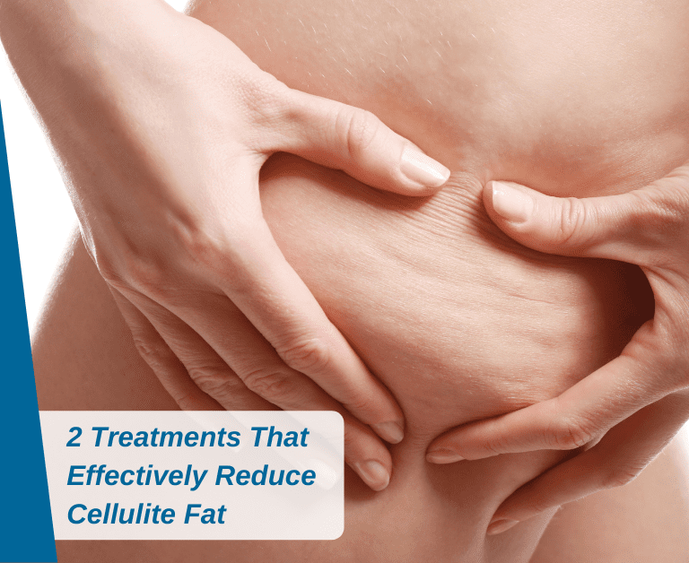Wear Your Summer Wardrobe With Confidence: 2 Treatments That Effectively Reduce Cellulite Fat