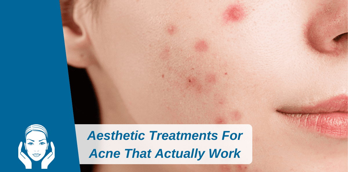 Aesthetic Treatments For Acne That Actually Work