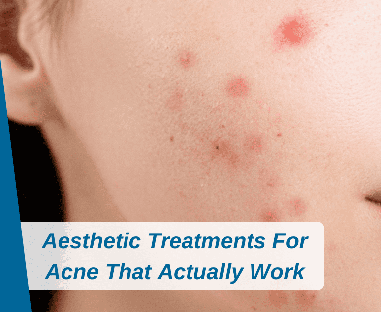 Aesthetic Treatments For Acne That Actually Work