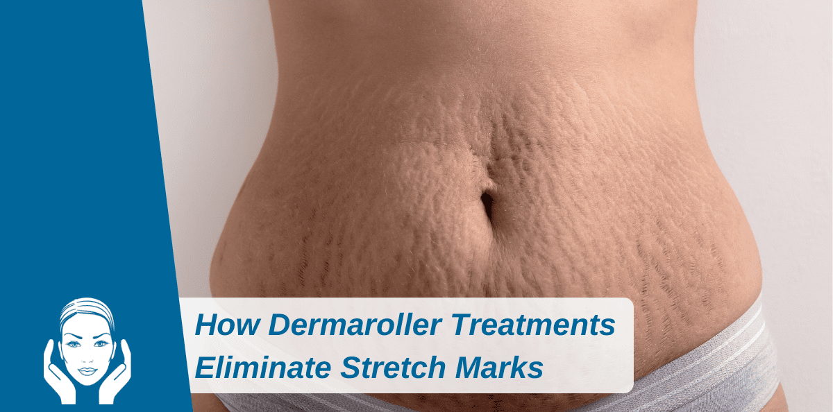 How Dermaroller Treatments Eliminate Stretch Marks