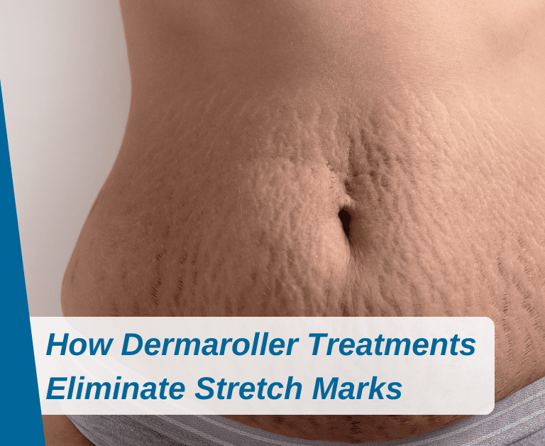 How Dermaroller Treatments Eliminate Stretch Marks