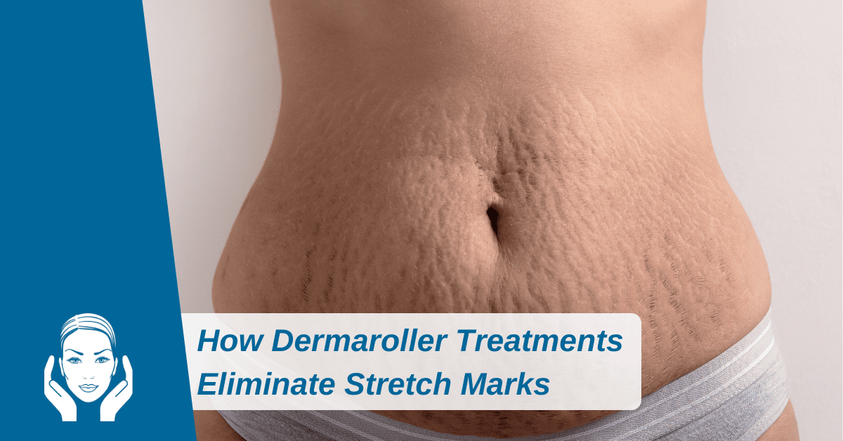 How Dermaroller Treatments Eliminate Stretch Marks