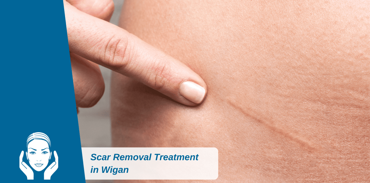 Scar Removal Treatment in Wigan