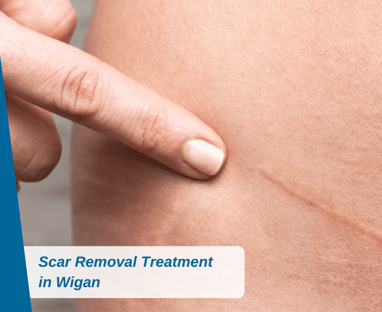 Scar Removal Treatment in Wigan